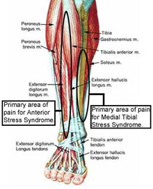 shin splint treatment
